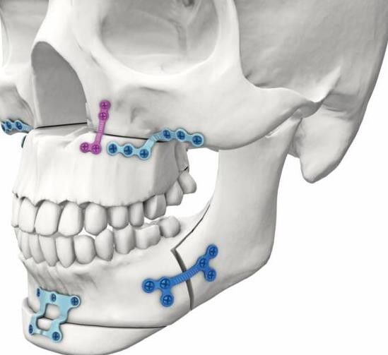 Челюстно лицевая. Титановые минипластины. Титановые минипластины в ЧЛХ. Реконструктивная хирургия ЧЛО.