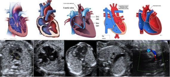 Гиперэхогенный фокус в желудочке сердца. Четырехкамерный срез сердца плода. Сердце плода на узи норма. Гиперэхогенный фокус в желудочке сердца. Гиперэхогенный фокус в желудочке сердца.